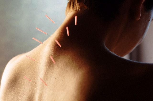 Acupuncture at Physio F/X in Scarborough 